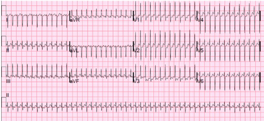 SVT EKG