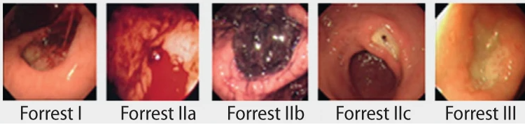 Forrest Sınıflaması