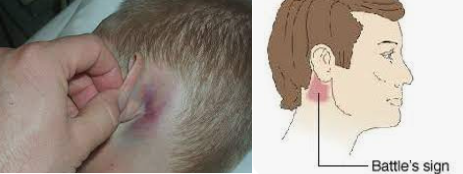 Travmalarda Battles sign bulgusu