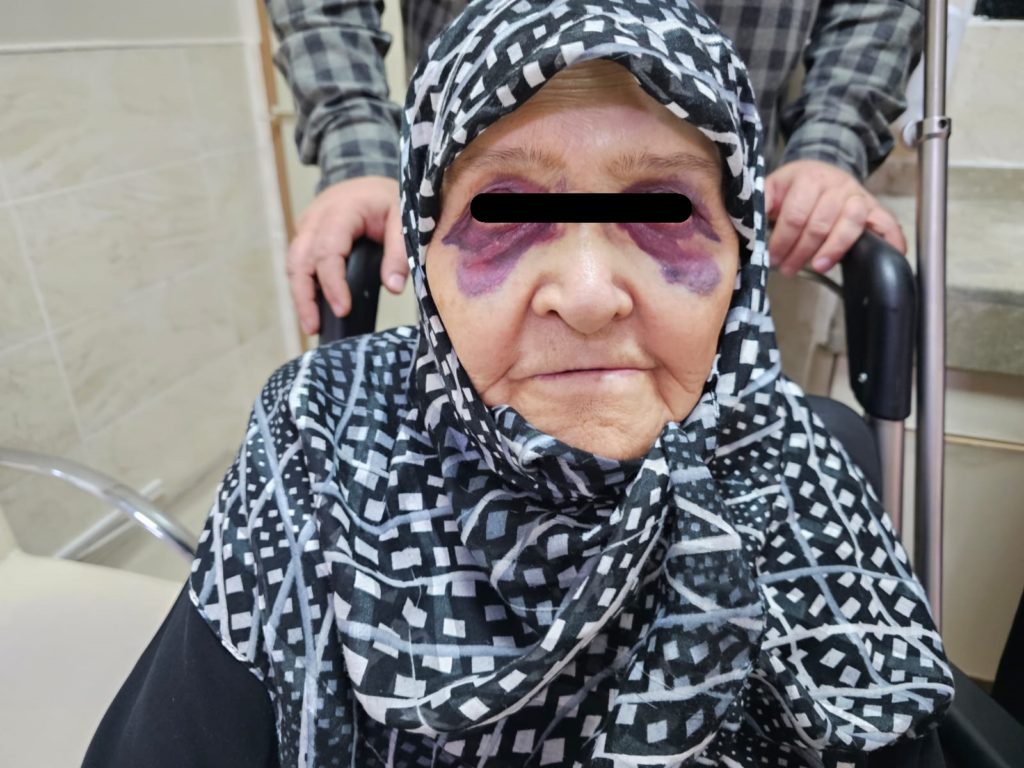 Raccon Eye Görünütüsü - kafa travması